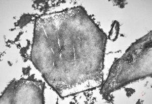 bone marrow … plasmocytoma (parafin-embedded sample) bone marrow … plasmocytoma (parafin-embedded sample)